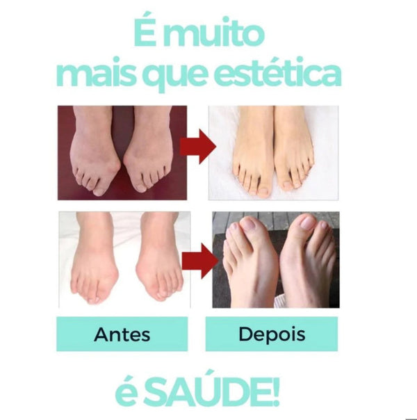 A Importância de Cuidar dos Pés: Como Corretores de Joanete Evitam Complicações Futuras