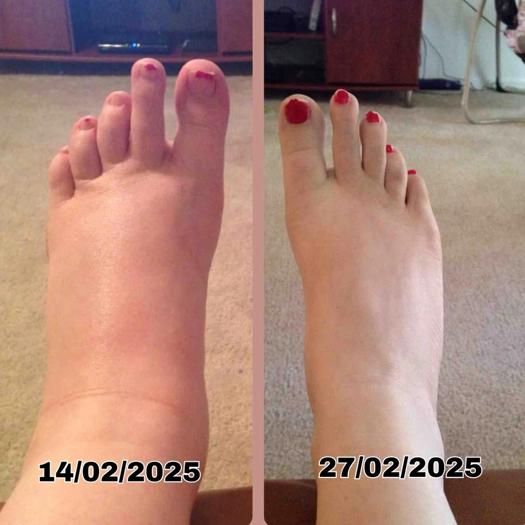 Aparelho De Laserterapia Para Neuropatia