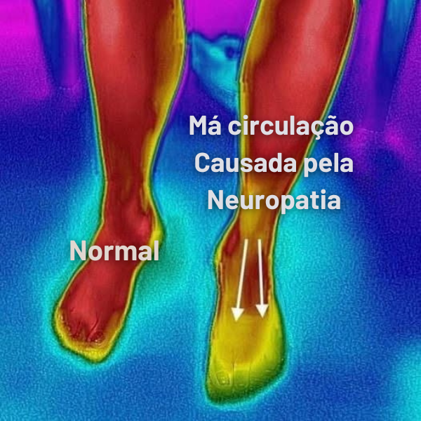 Aparelho De Laserterapia Para Neuropatia