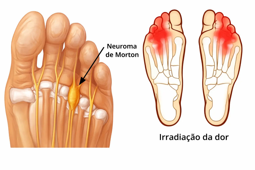 Palmilha Ortopédica Para Neuroma De Morton