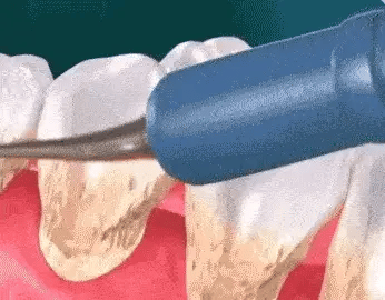 Aparelho de Limpeza Bucal Elétrico para Remover Tártaro e Placas