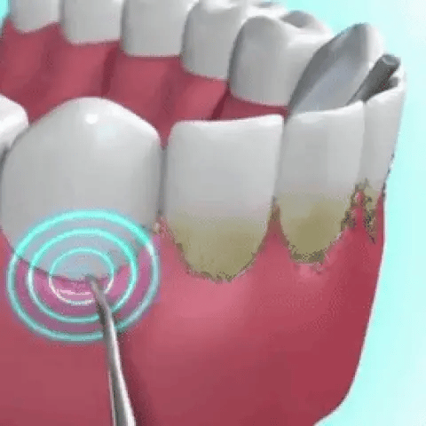 Aparelho de Limpeza Bucal Elétrico para Remover Tártaro e Placas