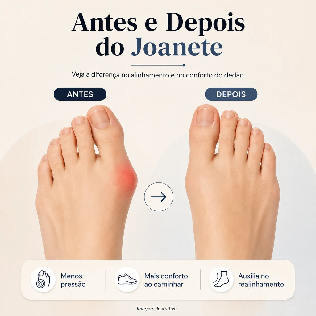 Corretor de Joanete Elétrico Profissional