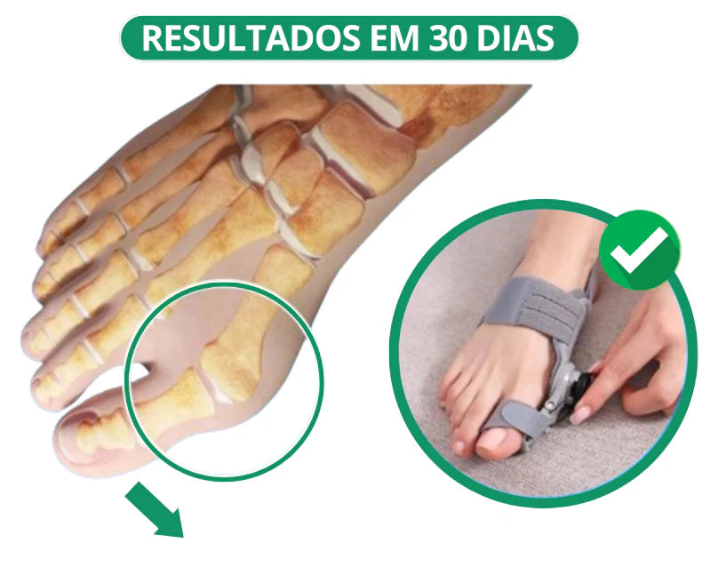 Corretor de Joanete Regulável