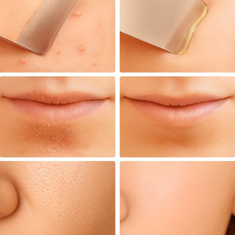 Peeling Esfoliante Ultrassônico Limpeza Facial e Removedor de Cravos